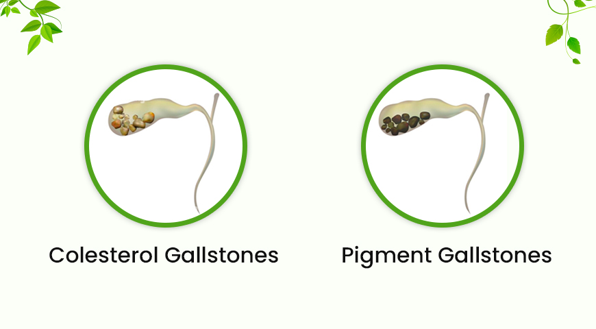 types of gall bladder stone