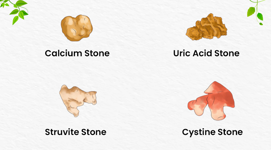 Types of Kidney Stone